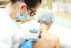 cosmetologist removes the tattoo to the patient us 2025 01 07 06 03 32 utc